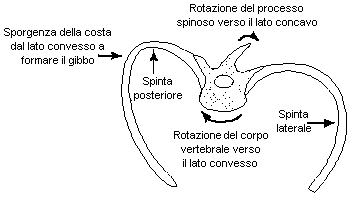 Torsione caratteristica delle vertebre e delle coste nella scoliosi toracica (veduta dal basso)